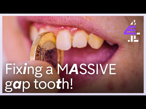 Download Fixing your GAP TOOTH | Body Fixers