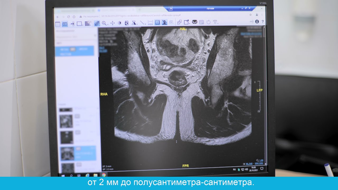 Лечение свища прямой кишки - YouTube