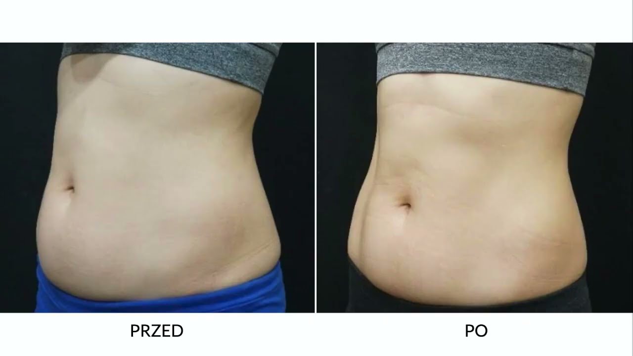 Clatuu Alpha - kriolizpoliza najnowszej generacji