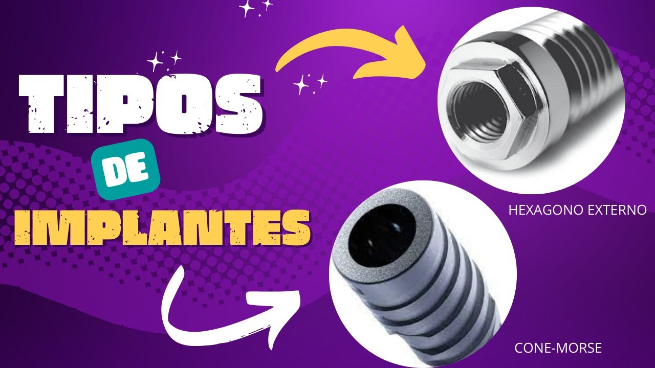 TIPOS DE IMPLANTE DENTÁRIO - HEXÁGONO EXTERNO x CONE-MORSE