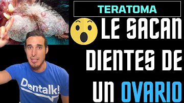 ¿Por qué los fibromas tienen pelo y dientes?