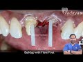 Smile correction with best quality tooth cap  crown by dr aaditya patakrao