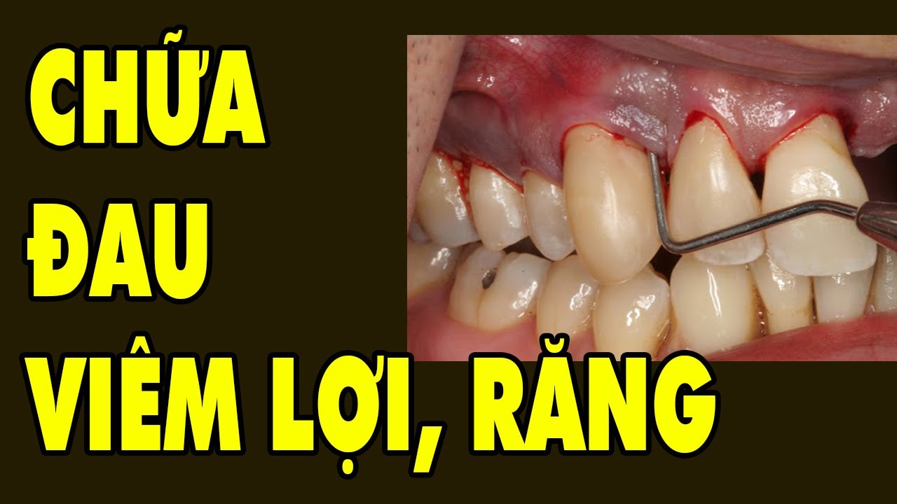 QUÁ HAY Cách Chữa Đau Răng Viêm Lợi- Lung Lay Răng -... - youtube