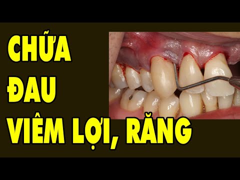 Video QUÁ HAY Cách Chữa Đau Răng Viêm Lợi- Lung Lay Răng -... - youtube