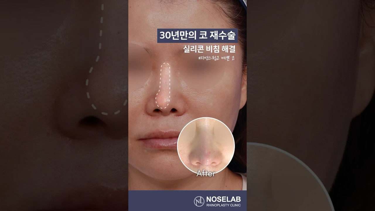 30년 만의 코재수술, 실리콘 비침 어떻게 해결할까? 강차영 원장이 설명하는 교정 포인트