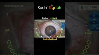 #03 Reverse opened phakic IOL management #phakiciol #eyesurgery #sudhirsignals