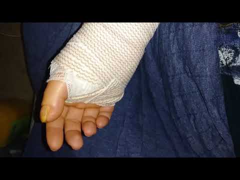 My Trigger Thumb Journey Part 3