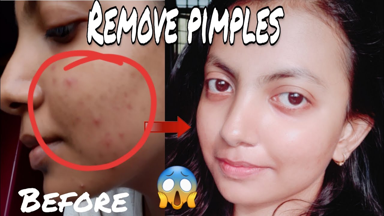 HOW TO REMOVE PIMPLES /ACNE OVERNIGHT ONLY 2 INGREDIENTS GREEN TEA