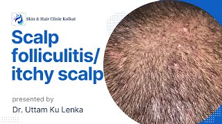 Scalp Folliculitis Treatment/ सर मैं दाना का इलाज/  Dr. Uttam Kumar Lenka, Consultant Dermatologist