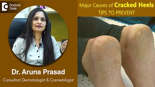 Major Tips to Prevent CRACKED HEELS | Fissure Feet | Cuts in Feet -Dr.Aruna Prasad| Doctors' Circle