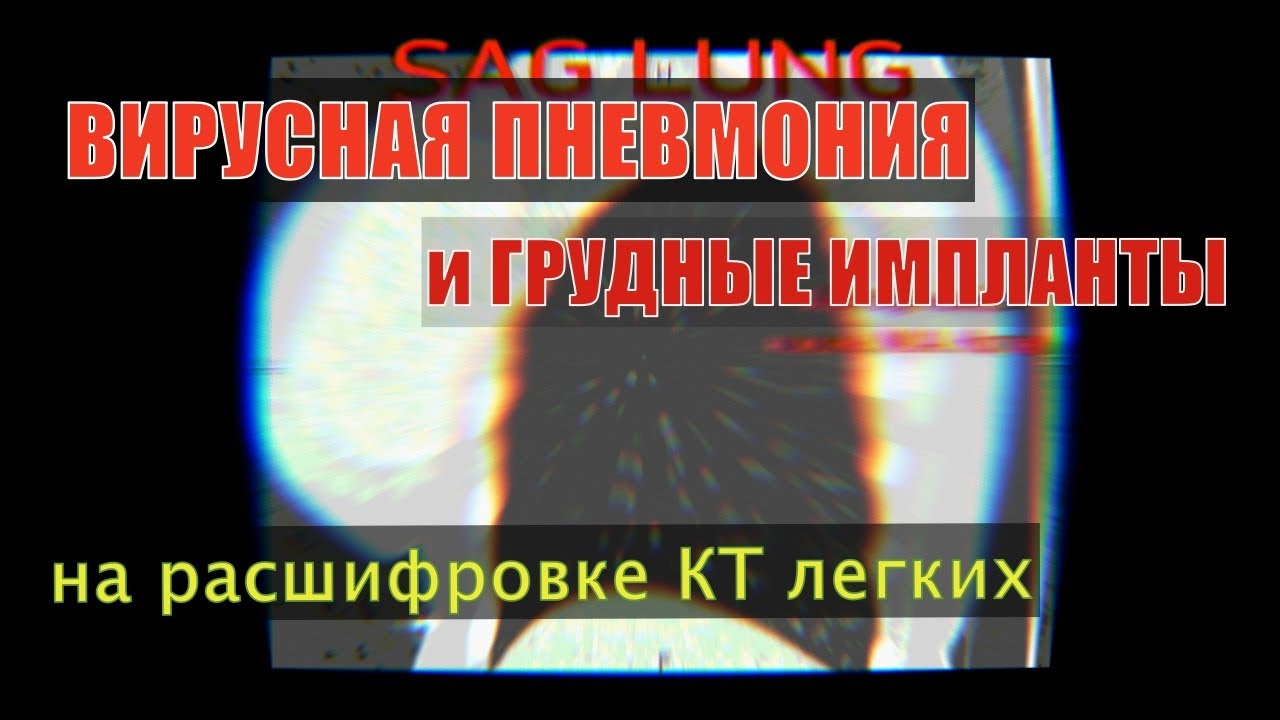 Состояние ИМПЛАНТОВ молочных желез при КТ картине ВИРУСНОЙ ПНЕВМОНИИ на ...