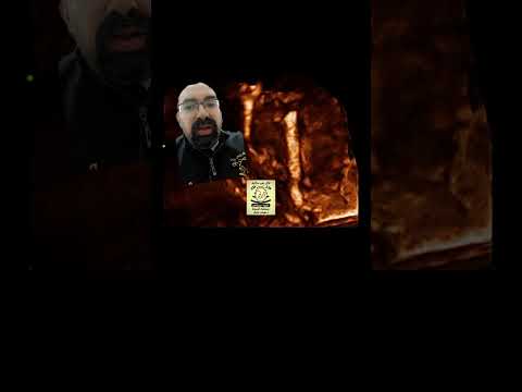 قصر عظمه الفخد احادي الجانب في الجنين تم تشخيصه بواسطه السونار رباعي الأبعاد د هيثم عارف التراسكان