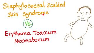 Staphylococcal Scalded Skin Syndrome V.s. Erythema Toxi Neonatorum