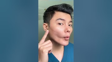 tiêm Filler kỹ thuật MDCode để nâng phần cơ má bị hóp