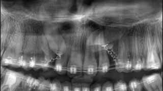 Ortodonti Tedavisi - Gömülü Diş Tedavisi