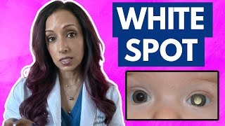 White Spot In Your Baby's Eye? Eye Doctor Explains