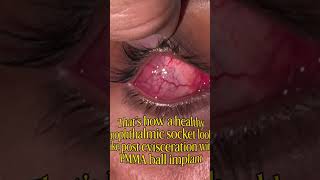 😳 😱 ਅੱਖ ਕੱਢਣ ਤੋਂ ਬਾਅਦ ਅੰਦਰ ਕੀ ਹੁੰਦਾ? Eye Socket Reality 😨#eyecare  #eyes  #doctor