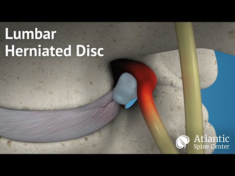Lumbar Herniated Disc Overview