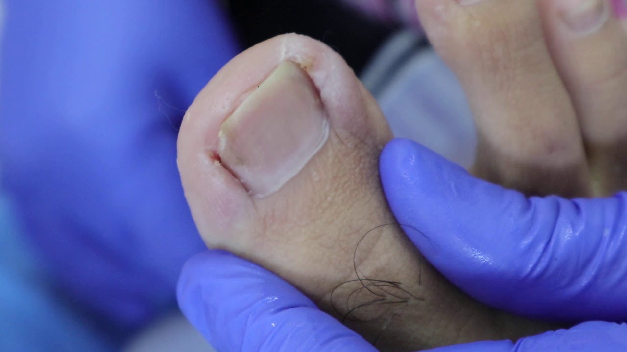 Ep_614 Ingrown nail removal 👣 เล็บบาน เล็บจิก เป็นอย่างไร? (This clip