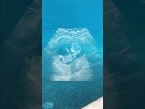 Video: Olycklig för att bli gravid? Fertilitetsbehandlingarna som kan fungera för dig