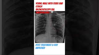 #bronchoscopy#chest#sputum#respiratory#TB#passion#awareness#lungs#xray#education#doctor#neetpg#air