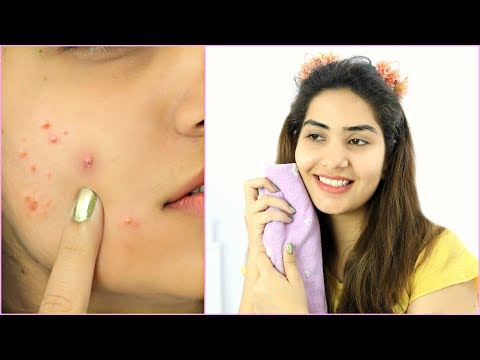 Acne, Pimples के लिए सबसे अच्छे Products कौन से हैं ? Best Skincare Routine | Anaysa