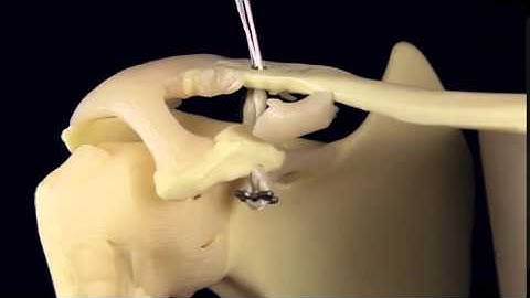 Double Endobutton Technique