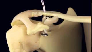 Double Endobutton Technique