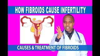 FIBROIDS & INFERTILITY; CAN FIBROIDS CAUSE INFERTILITY, TREATMENT, PREVENTION, conceive with fibroid