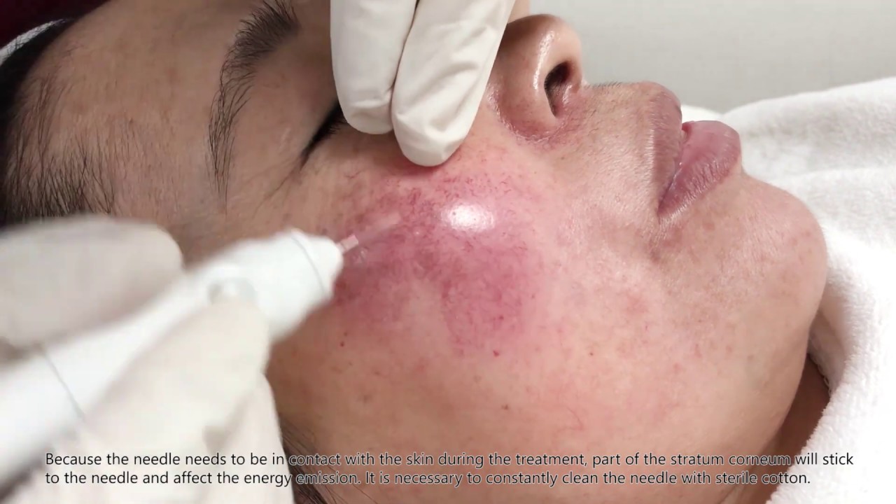 High Frequency RF Spider Vein Remval YouTube