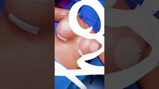 Amazing Breast Augmentation By The Amazing Dr. Sofer