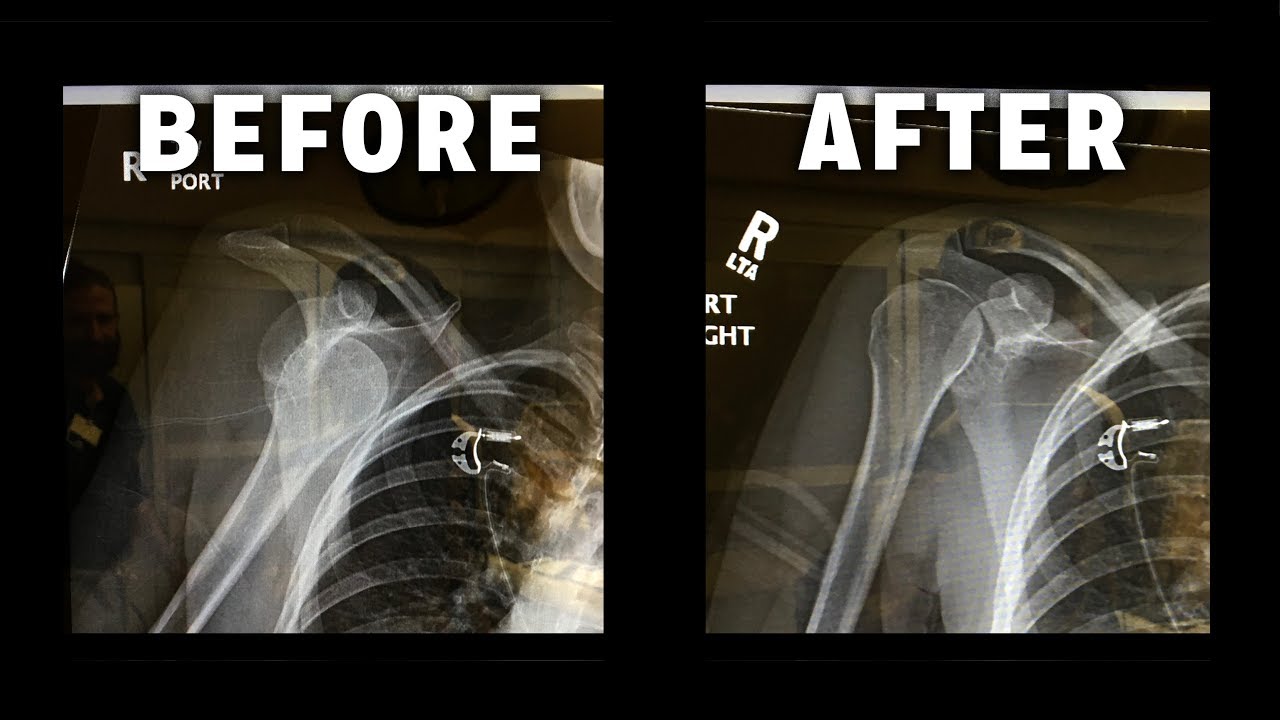 My Dog Dislocated My Shoulder! YouTube