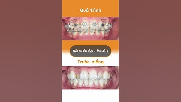 Hành trình LỘT XÁC nhờ niềng răng của Ngọc Diệp