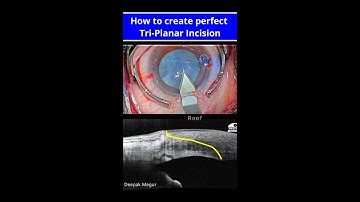 How to create Tri-planar incision, OCT image view. 1st Cataract Shorts video - Dr Deepak Megur