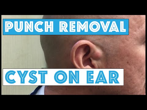 Cyst At The Base Of The Ear, Dedicated To Justin, Scott, & Spiegel On 98Rock Morning Show