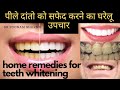 दांतों का पीलापन दूर करने के घरेलू उपचार,home remedies for teeth whitening safe and best methods