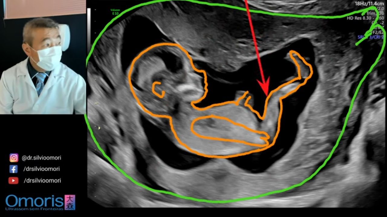 Ultrasound BABY SEX! 13 weeks. Boy or girl? - YouTube