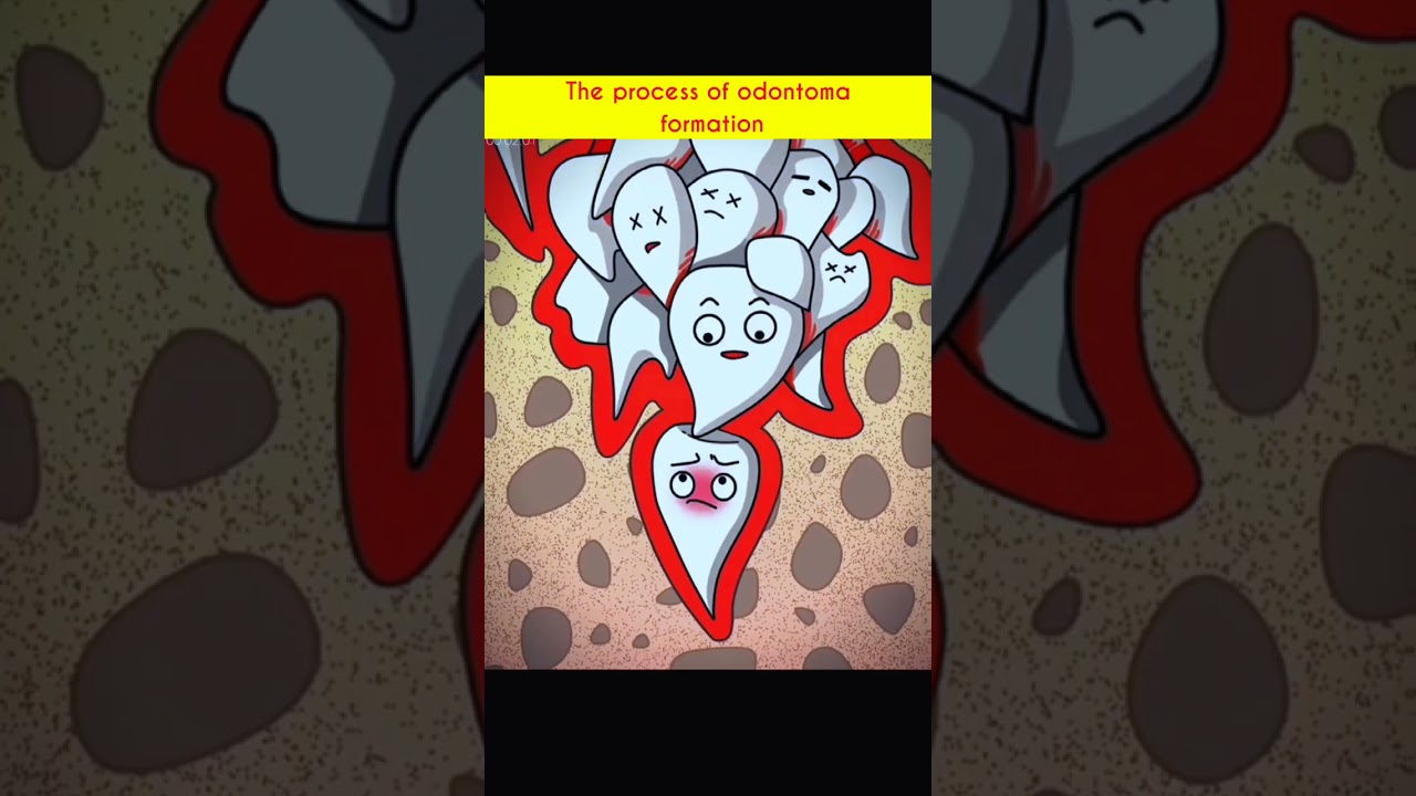The process of odontoma formation 