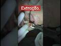 Extração ! Ultilizando forceps 18R , para molar superior direito