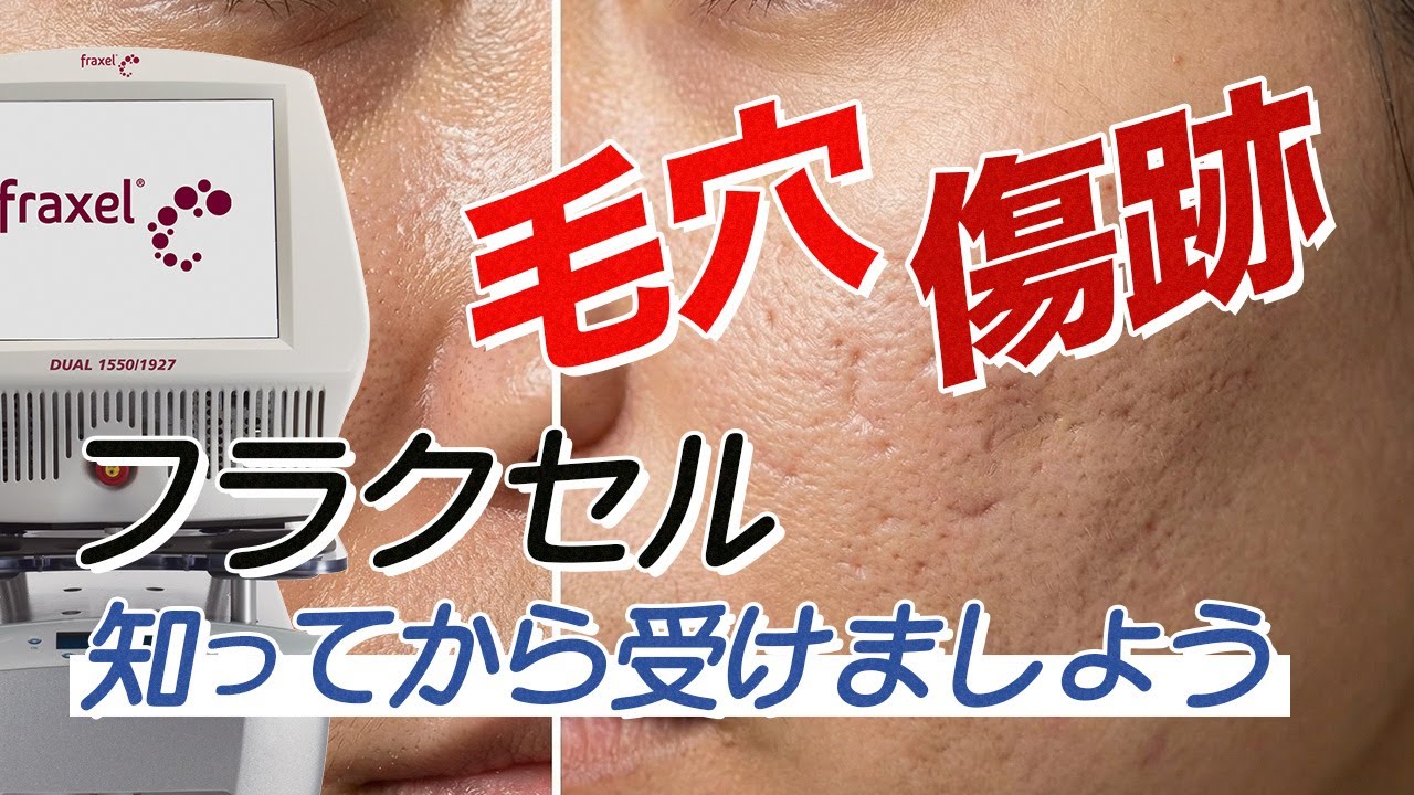ニキビ跡や毛穴で肌再生に悩んでいるなら？ フラクショナルレーザーは種類を正しく理解してから受けましょう！