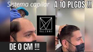 Prótesis capilar sistema cabello largo premium