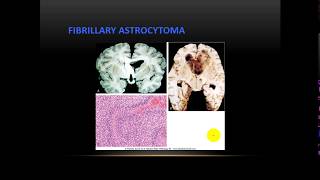 Patho - dr. Tahseen --  CNS Tumors  أورام الدماغ