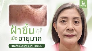 EP15 l รักษาฝ้ายังไงเมื่อเข้าสู่วัยทอง  l The Vive Clinic