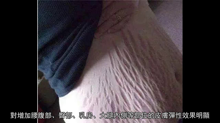 23岁辣妈晒肚子照吓得女网友惊呼不敢生孩子 妊娠纹可以这样预防 - 天天要闻