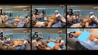 Prone Positioning & ARDS - 4