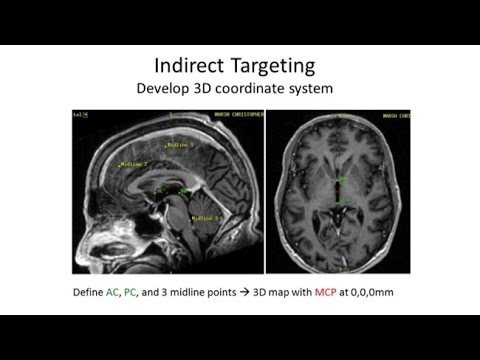 Deep Brain Stimulation - You Asked For It