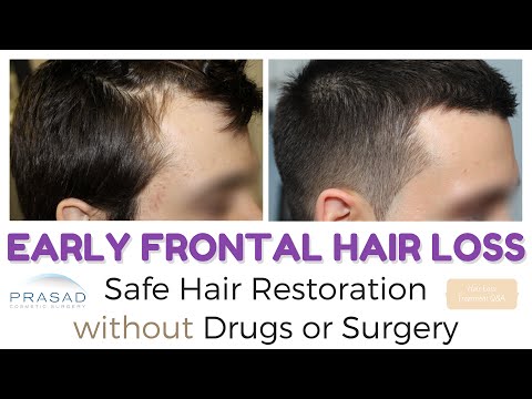 Frontal Hair Loss at 20 - Managing Hair Loss and Hair Thinning Safely without Surgery