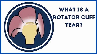 What is a rotator cuff tear?