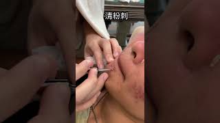 清粉刺blackhead removal @KTVmemencet komedo