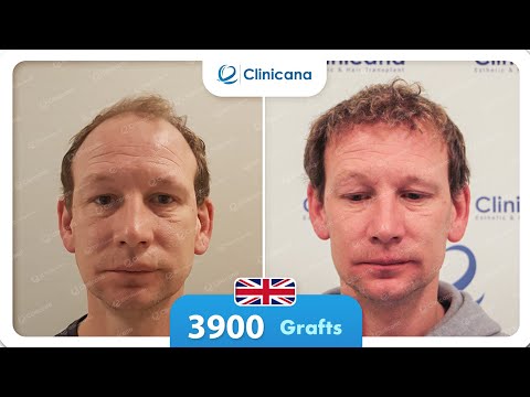 Damien’s hair transplant